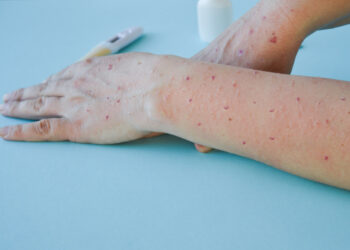 L’arrivée probable de cas de Mpox en France, avertit le ministère de la Santé