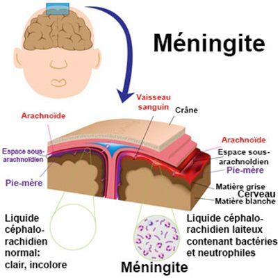 Comprendre la méningite : Symptômes, prévention et enjeux de santé publique