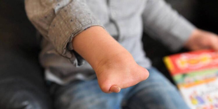 Une explosion troublante de naissances de bébés sans bras dans l’Ain – Midi Libre Une explosion troublante de naissances de bébés sans bras dans l’Ain – Midi Libre