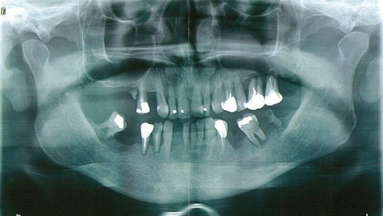 Dental Mutilations in Marseille: Lionel and Jean-Claude Guedj Sentenced for Good