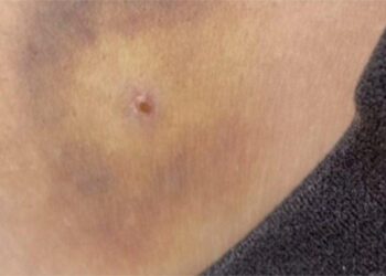 « Piqûres sauvages » à Nantes pendant la fête de la musique : aucune seringue retrouvée