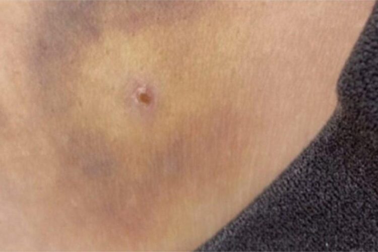 « Piqûres sauvages » à Nantes pendant la fête de la musique : aucune seringue retrouvée