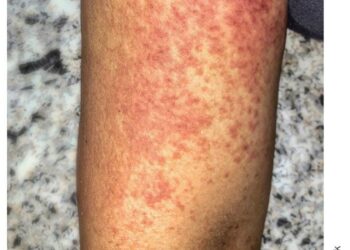 Chikungunya : premier cas de transmission confirmé en Alsace, une alerte sanitaire majeure