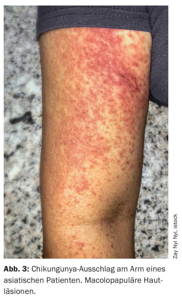 Chikungunya : premier cas de transmission confirmé en Alsace, une alerte sanitaire majeure